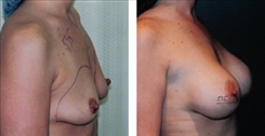 Breast Augmentation Patient Before & After Photo 1