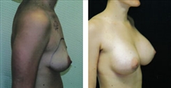 Breast Augmentation Patient Before & After Photo 1