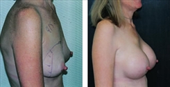 Breast Augmentation Patient Before & After Photo 1