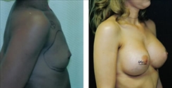 Breast Augmentation Patient Before & After Photo 1