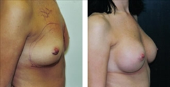 Breast Augmentation Patient Before & After Photo 1