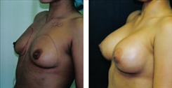 Breast Augmentation Patient Before & After Photo 1