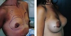 Breast Augmentation Patient Before & After Photo 1