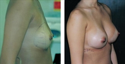 Breast Augmentation Patient Before & After Photo 1