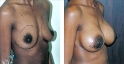 Breast Augmentation Patient Before & After Photo 1