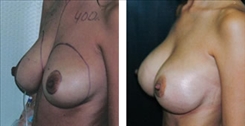 Breast Augmentation Patient Before & After Photo 1