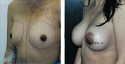 Breast Augmentation Patient Before & After Photo 1