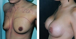 Breast Augmentation Patient Before & After Photo 1