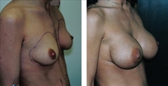 Breast Augmentation Patient Before & After Photo 1