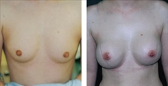 Breast Augmentation Patient Before & After Photo 1