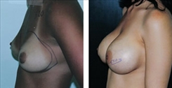 Breast Augmentation Patient Before & After Photo 1