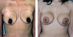 Breast Augmentation Patient Before & After Photo 1