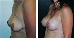 Breast Augmentation Patient Before & After Photo 1