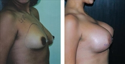 Breast Augmentation Patient Before & After Photo 1