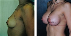 Breast Augmentation Patient Before & After Photo 1