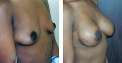 Breast Augmentation Patient Before & After Photo 1