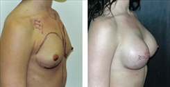 Breast Augmentation Patient Before & After Photo 1