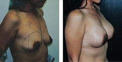 Breast Augmentation Patient Before & After Photo 1