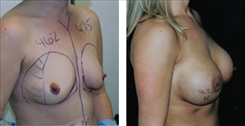 Breast Augmentation Patient Before & After Photo 1