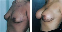 Breast Augmentation Patient Before & After Photo 1