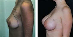 Breast Augmentation Patient Before & After Photo 1