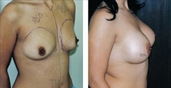 Breast Augmentation Patient Before & After Photo 1