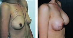 Breast Augmentation Patient Before & After Photo 1