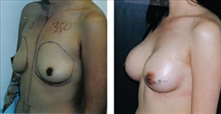 Breast Augmentation Patient Before & After Photo 1