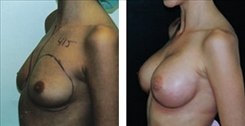 Breast Augmentation Patient Before & After Photo 1