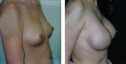 Breast Augmentation Patient Before & After Photo 1