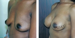 Breast Augmentation Patient Before & After Photo 1