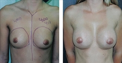 Breast Augmentation Patient Before & After Photo 1