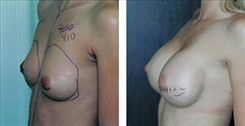 Breast Augmentation Patient Before & After Photo 1