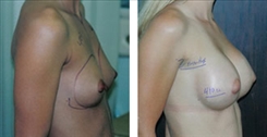 Breast Augmentation Patient Before & After Photo 1