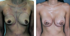 Breast Augmentation Patient Before & After Photo 1