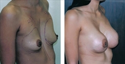 Breast Augmentation Patient Before & After Photo 1