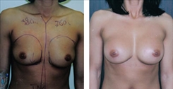 Breast Augmentation Patient Before & After Photo 1