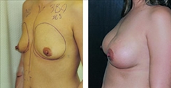 Breast Augmentation Patient Before & After Photo 1