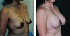 Breast Augmentation Patient Before & After Photo 1