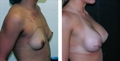 Breast Augmentation Patient Before & After Photo 1