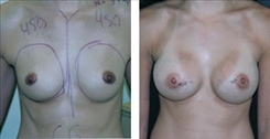 Breast Augmentation Patient Before & After Photo 1