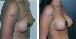 Breast Augmentation Patient Before & After Photo 1