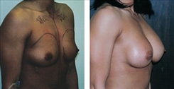 Breast Augmentation Patient Before & After Photo 1