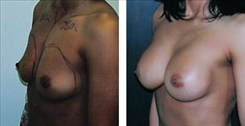 Breast Augmentation Patient Before & After Photo 1