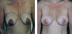 Breast Augmentation Patient Before & After Photo 1