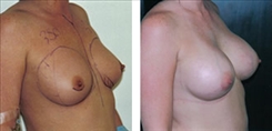 Breast Augmentation Patient Before & After Photo 1