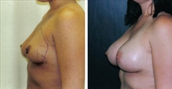 Breast Augmentation Patient Before & After Photo 1