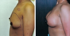 Breast Augmentation Patient Before & After Photo 1