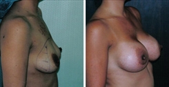 Breast Augmentation Patient Before & After Photo 1