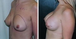 Breast Augmentation Patient Before & After Photo 1